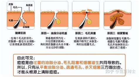 山根長痘|山根长了一个硬硬的痘痘